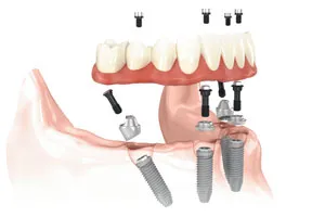 All-on-4 Treatment Concept digital illustration showing all components