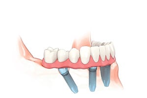All-on-4 Treatment Concept digital illustration showing the placed dentures