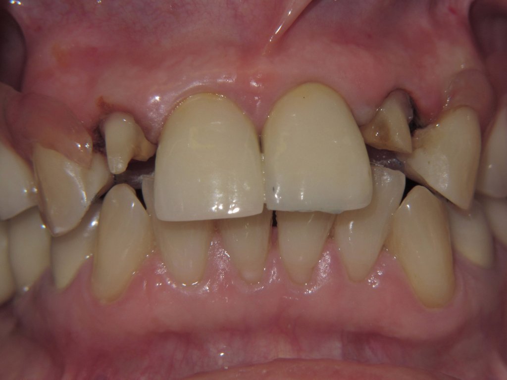 Patient's teeth before dental implant-supported bridge