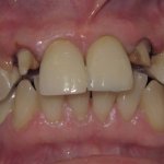 Patient's teeth before dental implant-supported bridge