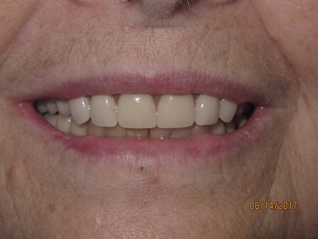 Patient's smile after dental implant-supported bridge