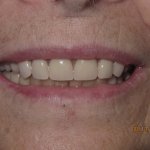 Patient's smile after dental implant-supported bridge