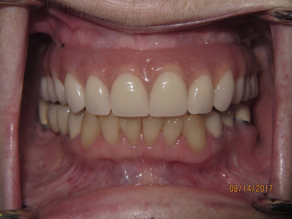 Patient's teeth after dental implant-supported bridge
