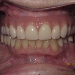 Patient's teeth after dental implant-supported bridge