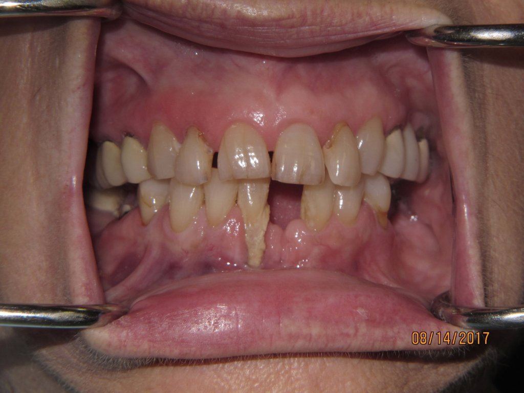 Patient's teeth before dental implant-supported bridge