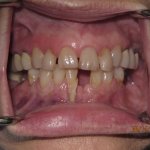 Patient's teeth before dental implant-supported bridge