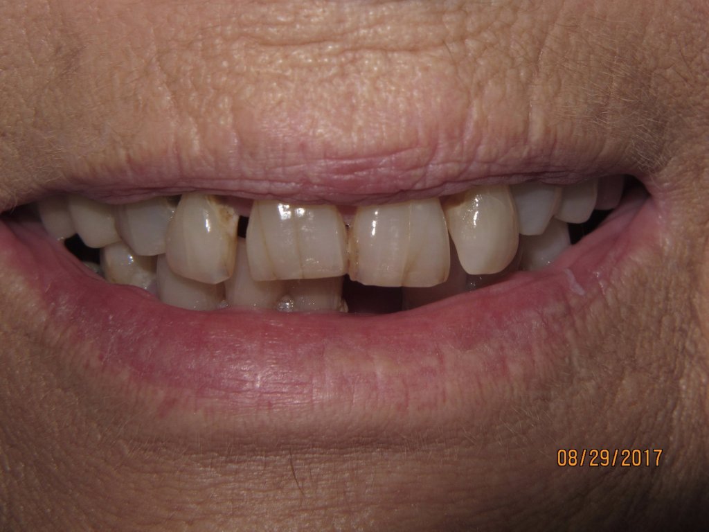 Patient's smile before dental implant-supported bridge