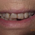 Patient's smile before dental implant-supported bridge