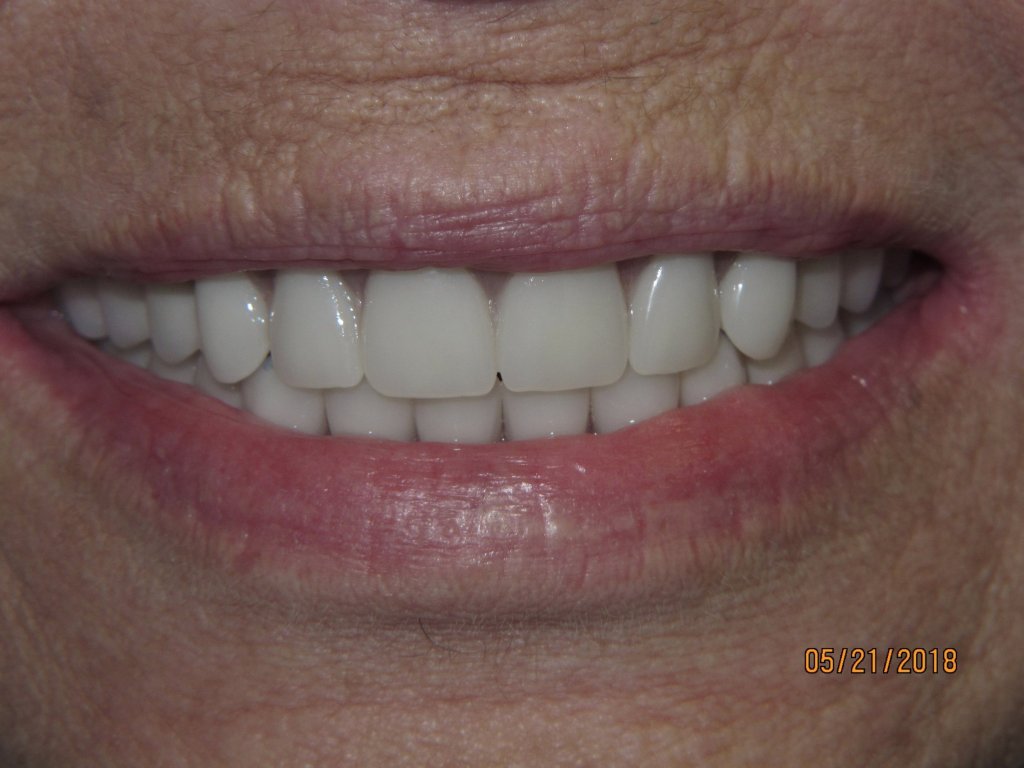 Patient's smile after dental implant-supported bridge