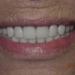 Patient's smile after dental implant-supported bridge