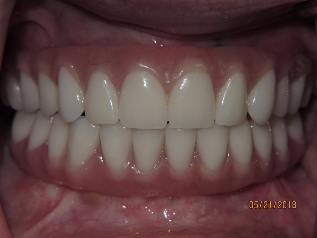 Patient's teeth after dental implant-supported bridge
