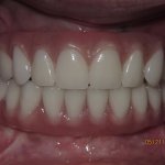 Patient's teeth after dental implant-supported bridge