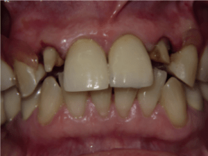 Patient's teeth before dental implant-supported bridge