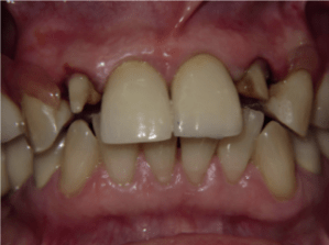 Patient's teeth before dental implant-supported bridge