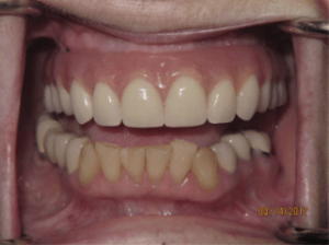 Patient's teeth after dental implant-supported bridge