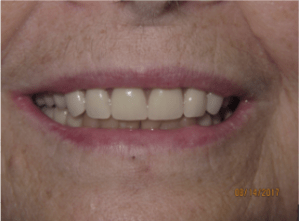 Patient's smile after dental implant-supported bridge