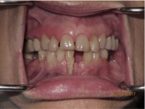 Patient's teeth before dental implant-supported bridgework