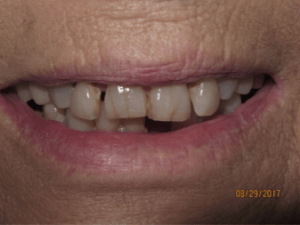Patient's smile before dental implant-supported bridgework