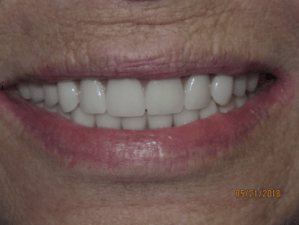 Patient's smile after dental implant-supported bridgework