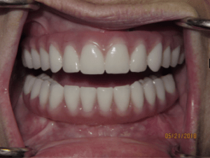 Patient's teeth after dental implant-supported bridgework
