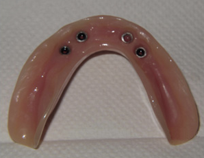 Lower denture with points to attach to dental implants