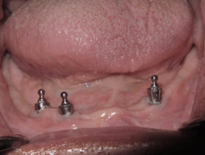 Dental implants in a patient's mouth