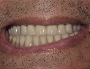Patient's smile with implant-supported dentures