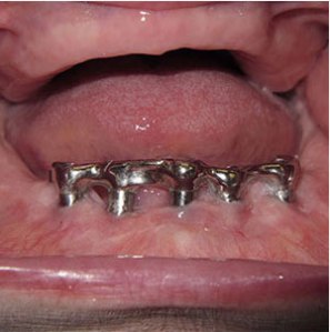 Dental implants with a bar in a patient's mouth
