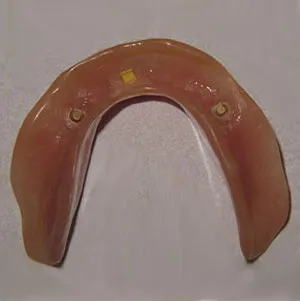 Lower denture with points to attach to dental implants