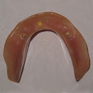 Lower denture with points to attach to dental implants