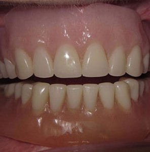 Patient's teeth with implant-supported dentures