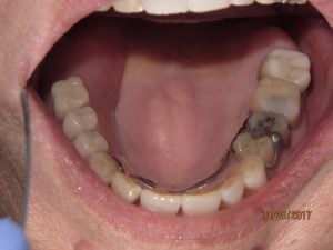 Patient's lower teeth before fixed bridgework
