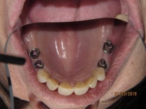 Patient's lower teeth with placed implants
