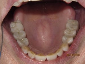 Patient's lower teeth after fixed bridgework
