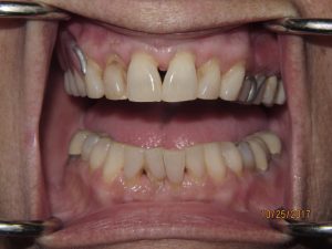 Patient's teeth before fixed bridgework