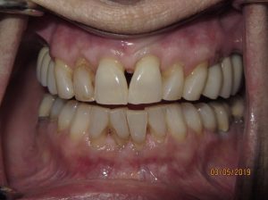 Patient's teeth after fixed bridgework