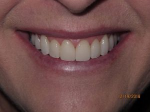 Smile after porcelain veneers photo