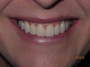 Smile after porcelain veneers photo