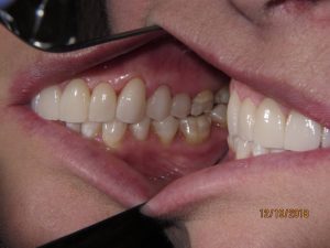 Teeth after porcelain veneers photo