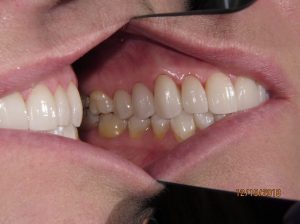 Teeth after porcelain veneers photo