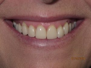 Smile before porcelain veneers photo