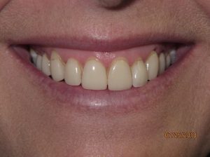 Smile before porcelain veneers photo