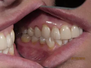 Teeth before porcelain veneers photo