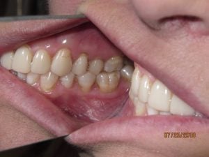 Teeth before porcelain veneers photo