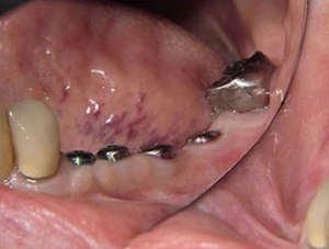 Patient's teeth with four individual dental implants