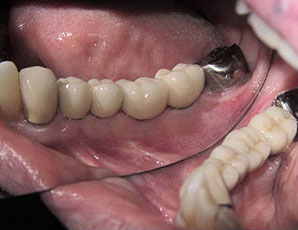 Patient's teeth with four placed dental crowns