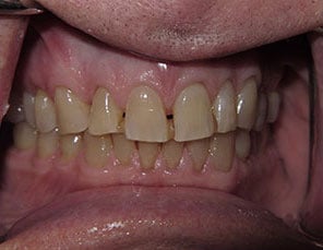 Teeth before teeth whitening and space closure photo