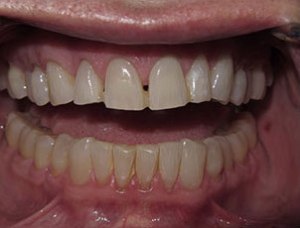 Teeth after teeth whitening but before space closure photo