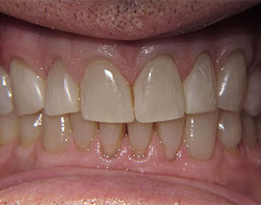 Teeth after teeth whitening and space closure photo
