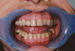 Teeth before dental crowns photo